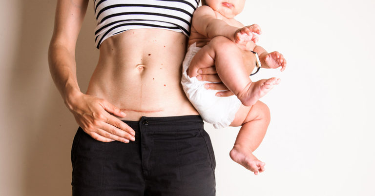 Moms Are Sharing Powerful Photos To End C-Section Shaming - Featured image
