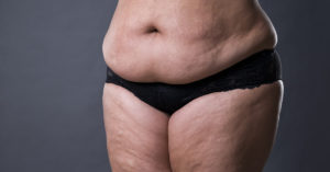 Mom Bods Deserve To Be Accepted Just As Much As Dad Bods : Secret Life