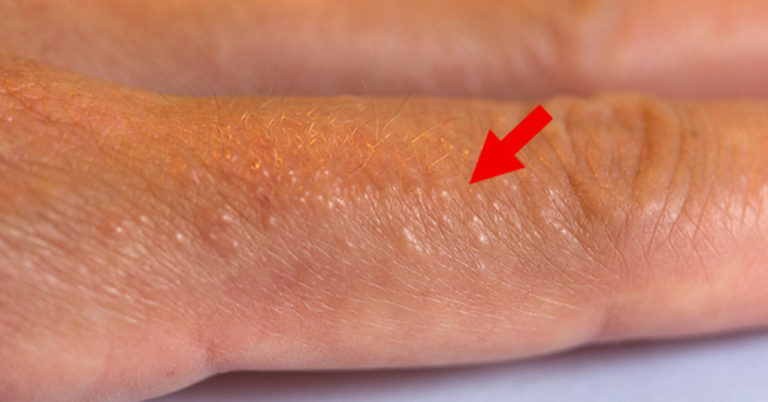 If You See These Painful Red Bumps, You May Have Dyshidrotic Eczema - Featured image