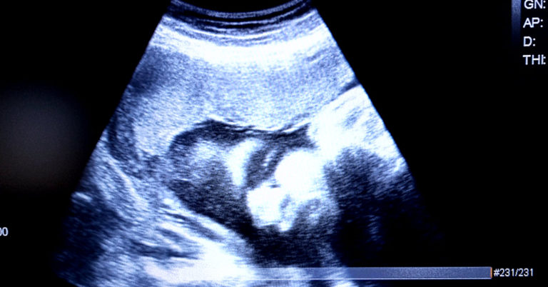 12 of the Weirdest and Most Beautiful Things Parents Have Seen in Baby’s Ultrasound - Featured image