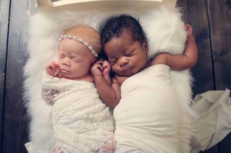 Photographer Gives Birth to Albino Twins - Secret Life Of Mom