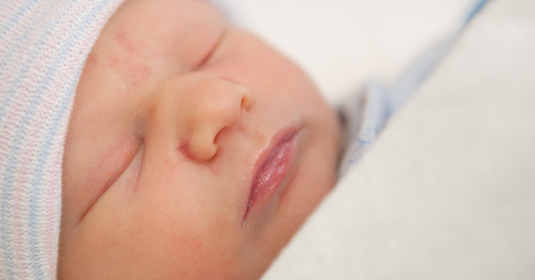 Mother Refuses To Have Her Baby Daughter’s Birthmark Removed Saying She Should Decide On Her Own When She Is Older - Featured image