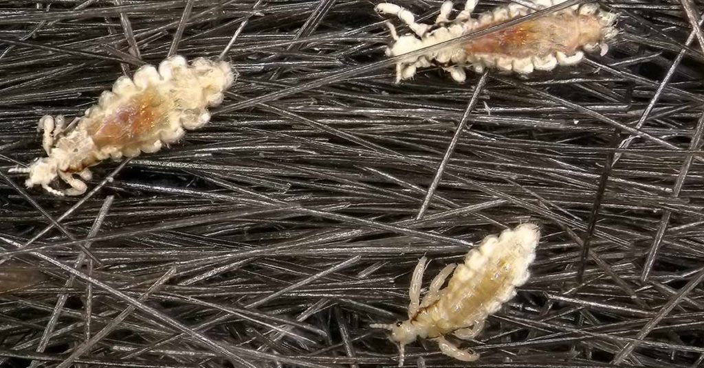 Teen girl so infested with head lice they’re “drinking blood out her face” - Featured image