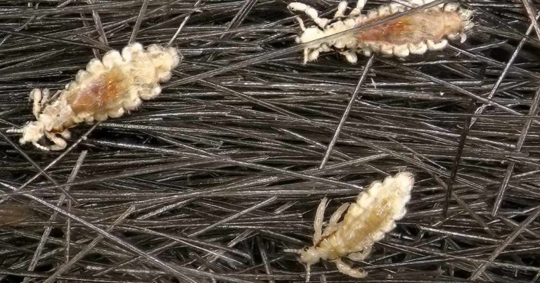 Teen girl so infested with head lice they’re “drinking blood out her face” - Featured image