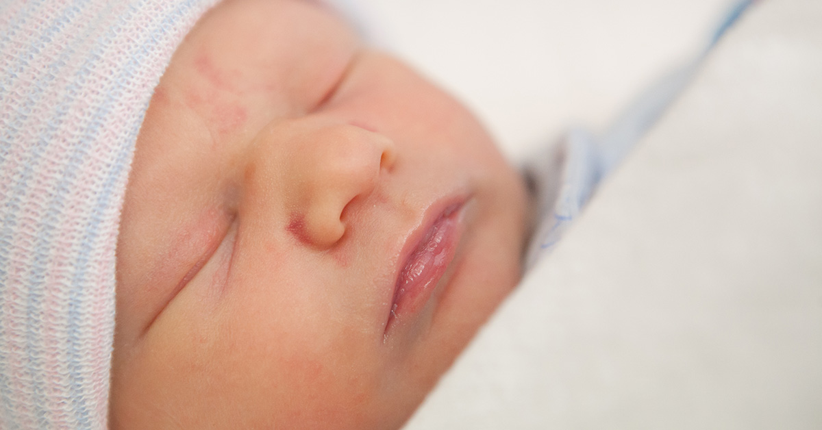 newborn with birthmark sleeping