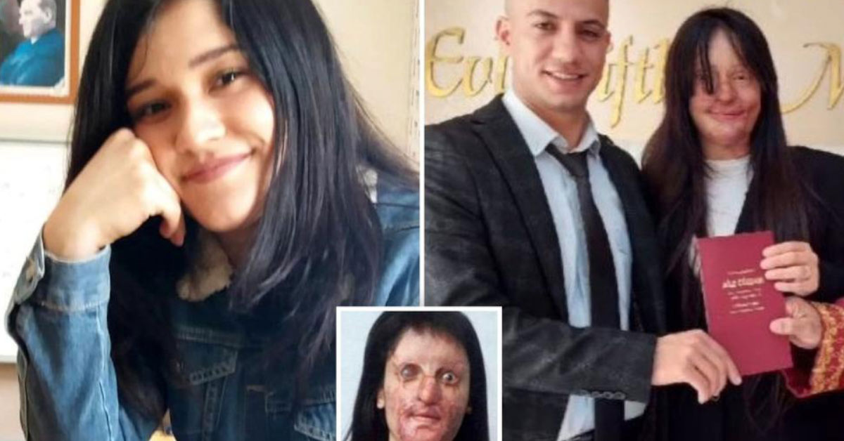 Enraged boyfriend threw acid on her face — but she still married him