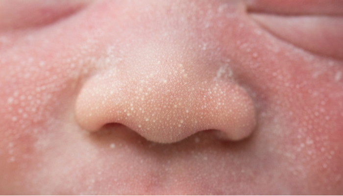 Close-up shot of the milia on a two-day-old baby cheek, nose, and forehead