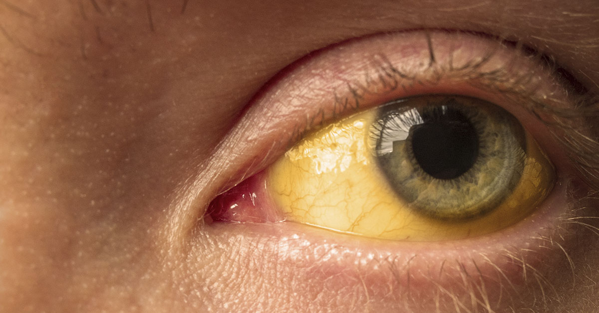 Jaundiced yellow eye