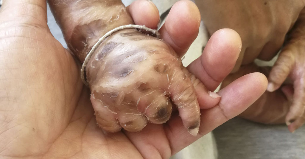 Infant born with  rare skin condition becomes miracle to parents - Featured image