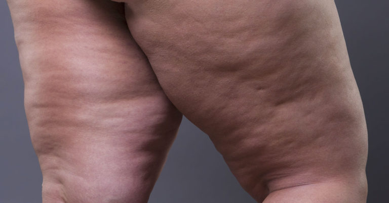 Bullies Mock Her “Disgusting” Legs – Then She Takes a Close-Up and Silences Everyone - Featured image