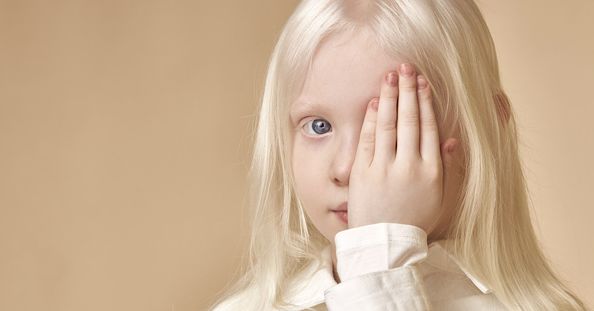 young albino girl covering one eye with her hand