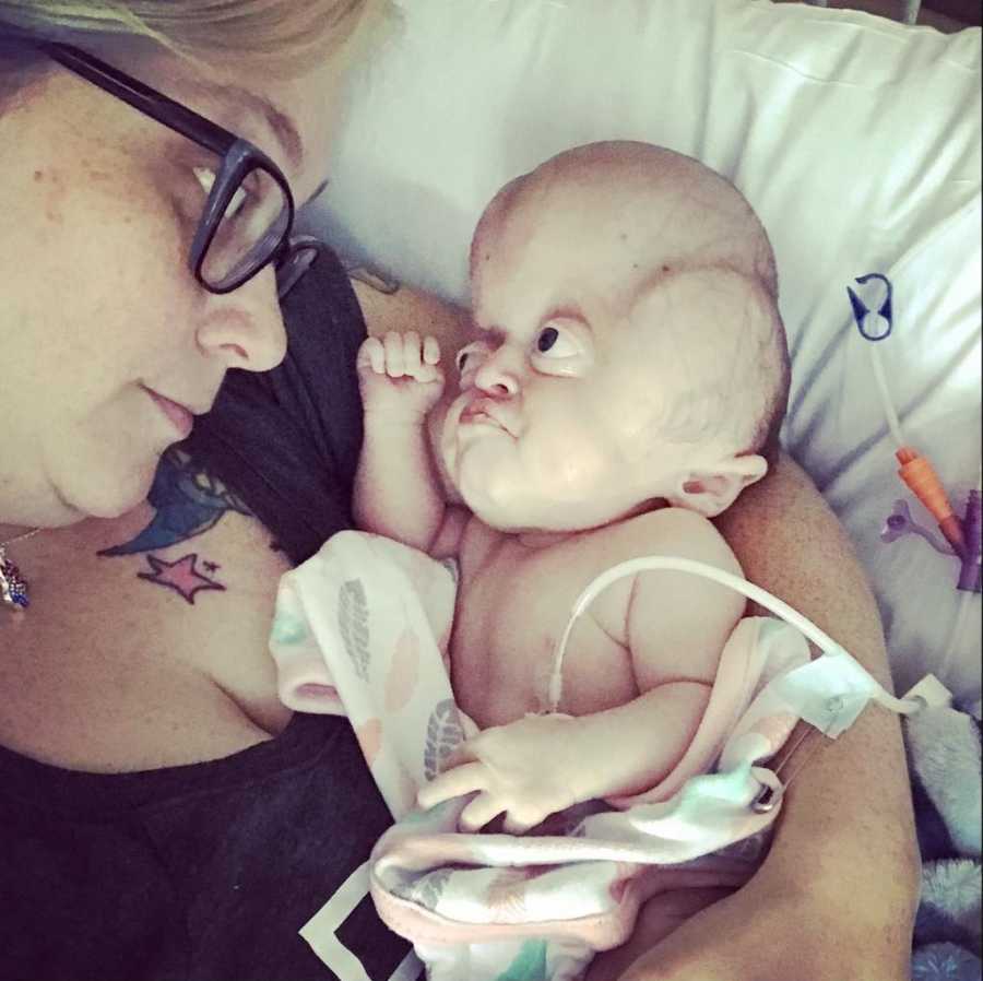  Amanda Schuster and her daughter Emmy. Emmy was born with Pfeiffer Syndrome