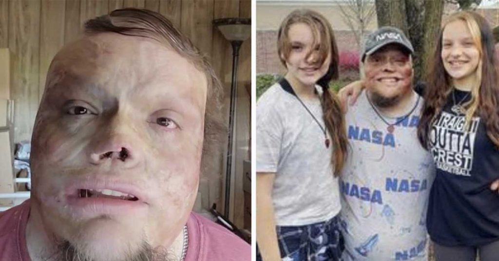 He suffered 98% burns as a toddler, but now he's raised two kids as a ...