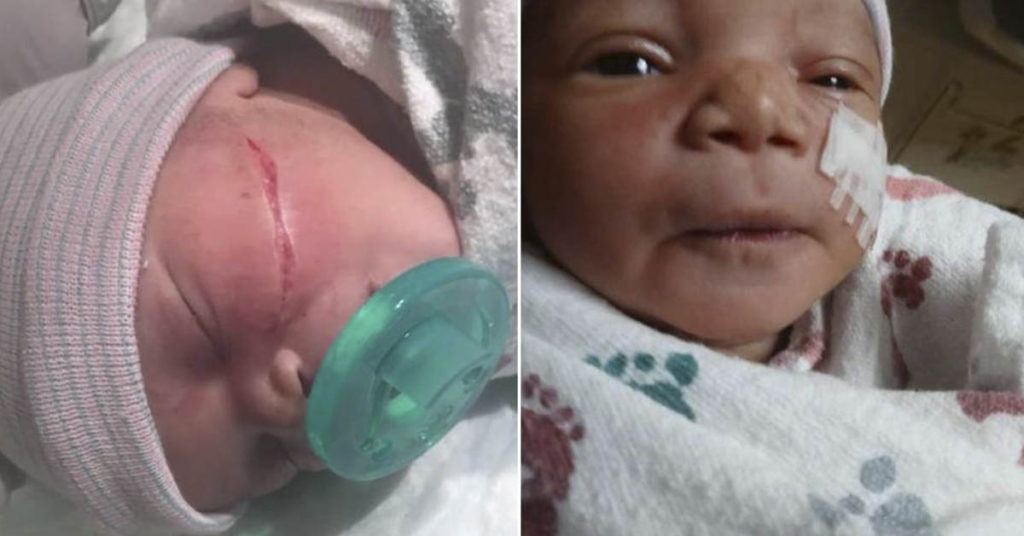 Newborn’s face sliced open during emergency C-section