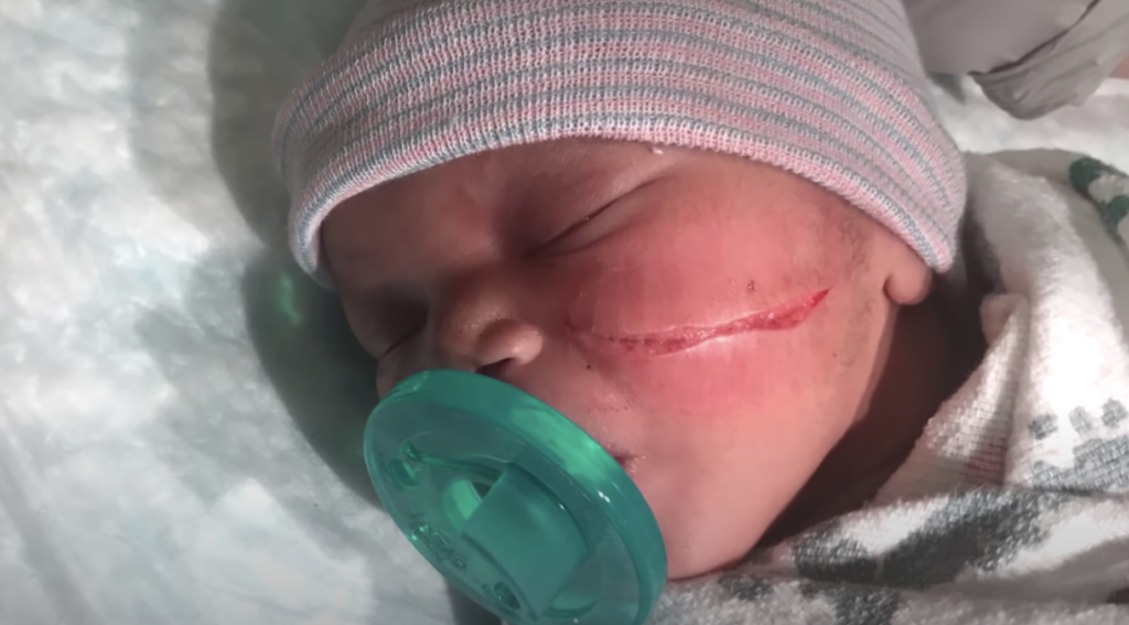 a baby who sustained a cut from a c section 