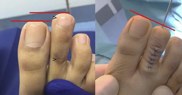 Toe Shortening Is A Thing And It's More Common Than You Think