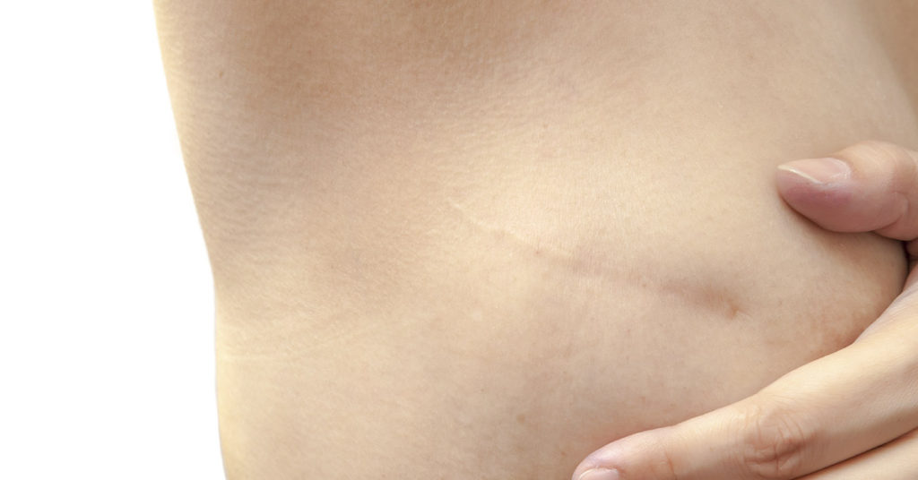 Women Who’ve Gone ‘Flat’ After Mastectomies Are Baring Their Chests — & Their Truths - Featured image