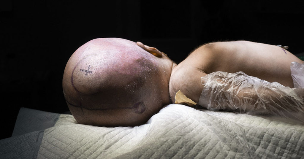 Overcoming Hydrocephalus: The Miracle Story of Parker Grelecki - Featured image