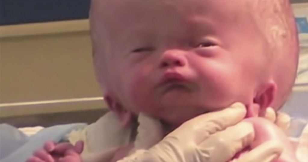 You Won't Recognize This Baby Now. What a Miracle!