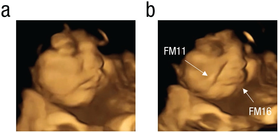 A) baseline. B) kale exposed fetus