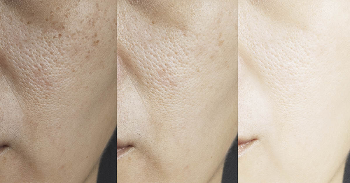 three pictures compared effect Before and After treatment. skin with problems of freckles , pore , dull skin and wrinkles before and after treatment to solve skin problem for better skin result