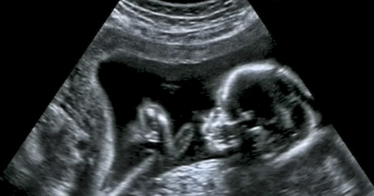 Tomm Tennent: The unique baby born with enough skin for a five-year-old child - Featured image