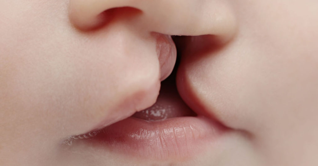 Boy born with ‘two faces’ because of ‘Sonic Hedgehog’ gene - Featured image