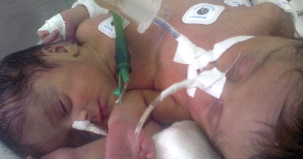 20 years ago this ‘unusual’ set of conjoined twins were born – now they’re all grown and enjoying life - Featured image