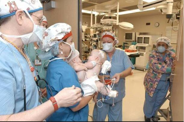 Surgery for the conjoined twins