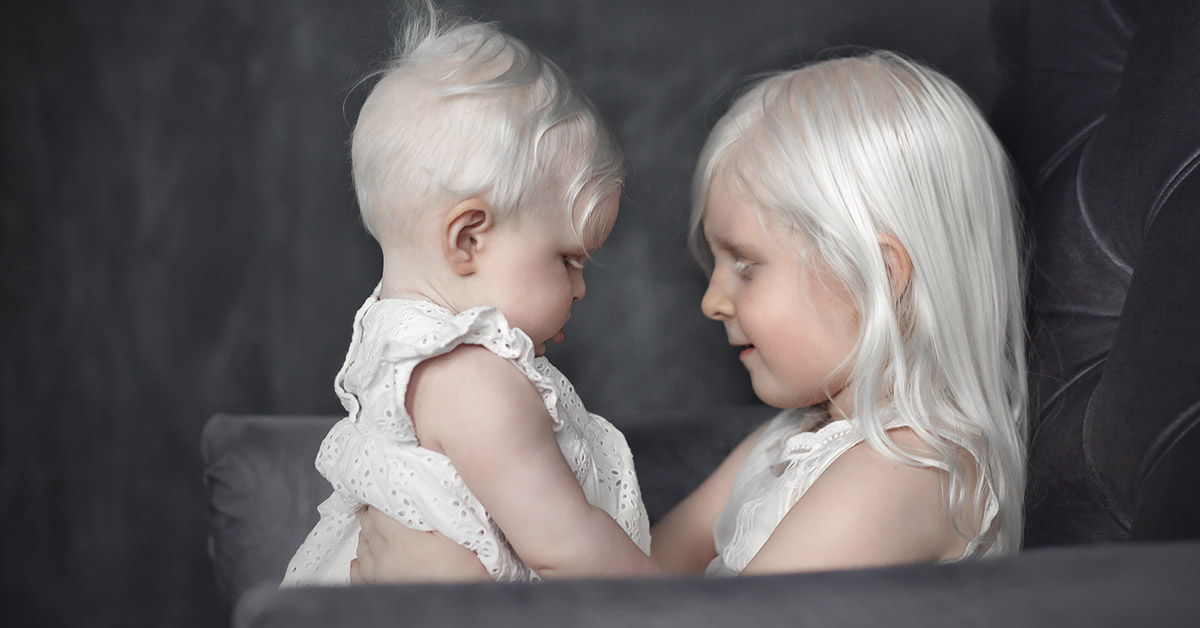 two albino children
