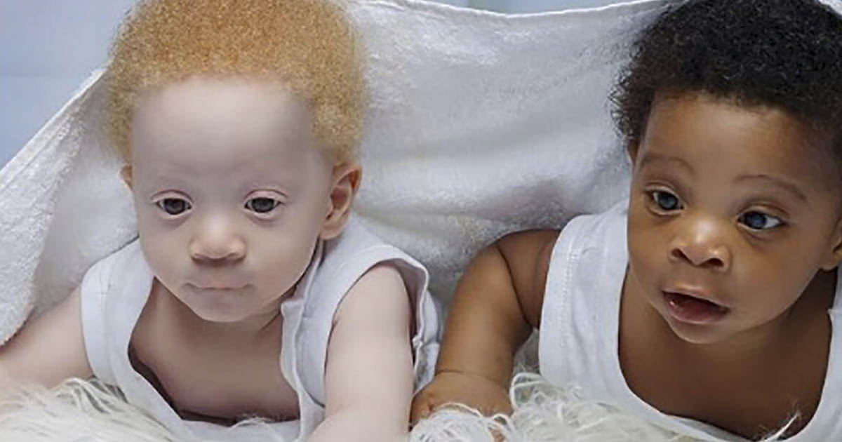 Nigerian Couple Gives Brith To Black And White Twins Secret Life Of Mom 