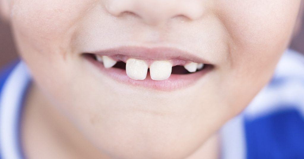 Classmates Called Him “Rabbit Kid” But Community Donates $100k To Give Him The Brightest Smile - Featured image