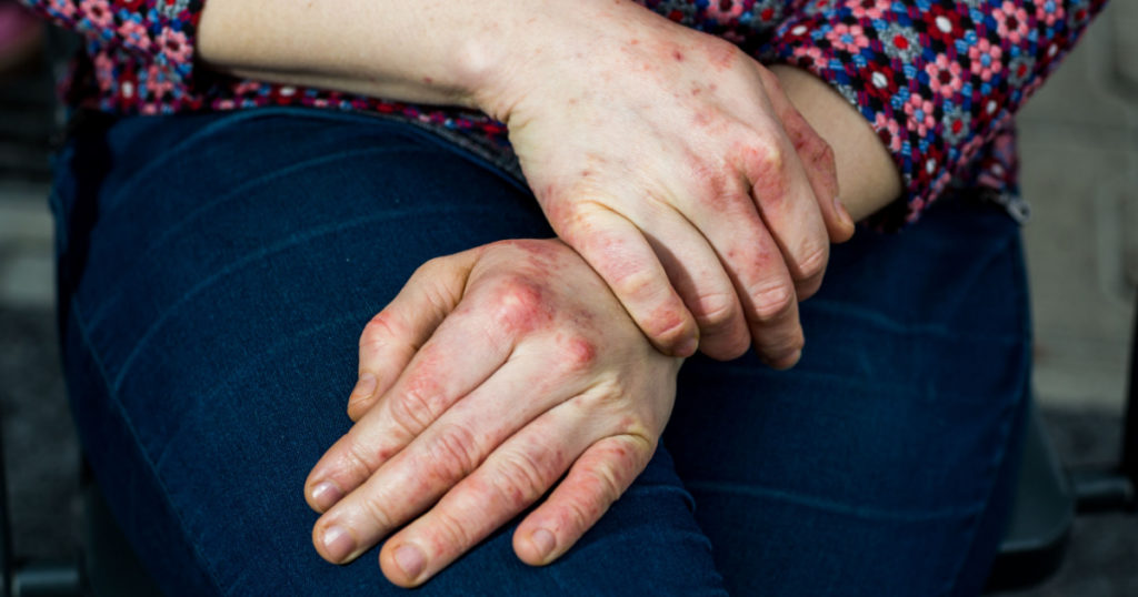 Detailed views of a young woman with dry and stressed red dyshidrotic eczema covered hands
