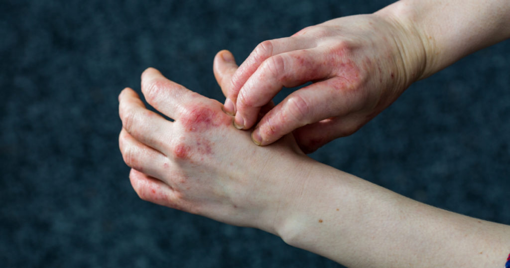 Detailed views of a young woman with dry and stressed red dyshidrotic eczema covered hands
