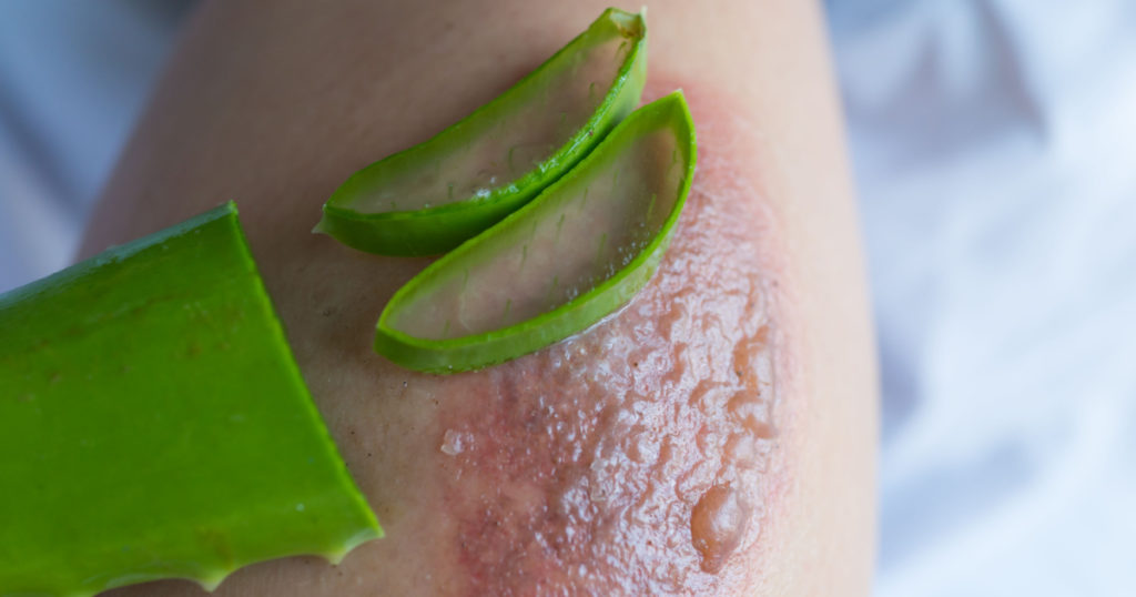 Aloe vera treatment in the blisters caused by a fire.
