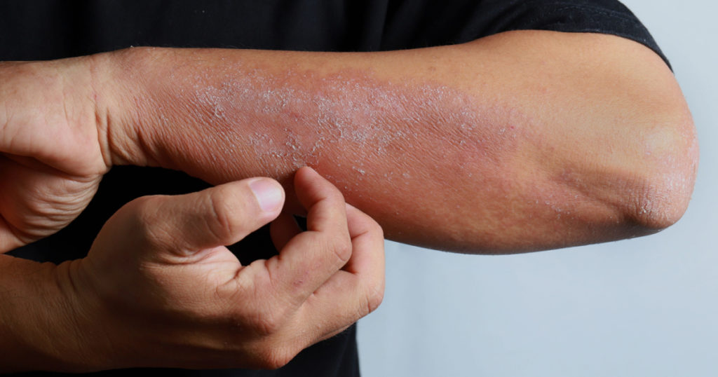 Close up dermatitis on man hand, allergic rash dermatitis eczema skin of a patient. Atopic dermatitis symptom skin detail texture, Fungus of skin. The concept of dermatology.

