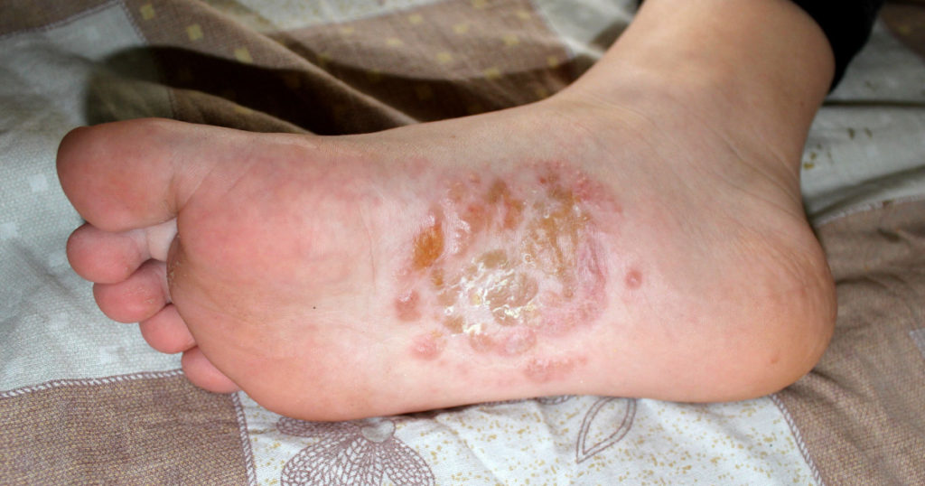 Dyshidrotic eczema (pompholux) of the sole.
