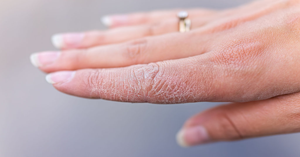 Dry cracked skin macro closeup of index finger of female young woman's hand showing eczema medical condition called dyshidrotic pompholyx or vesicular dyshidrosis
