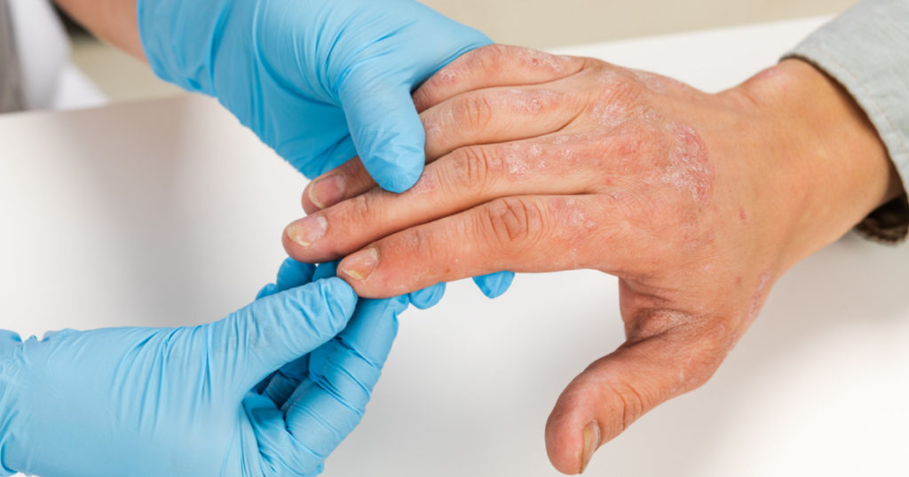 A dermatologist wearing gloves examines the skin of a sick patient. Examination and diagnosis of skin diseases-allergies, psoriasis, eczema, dermatitis.
