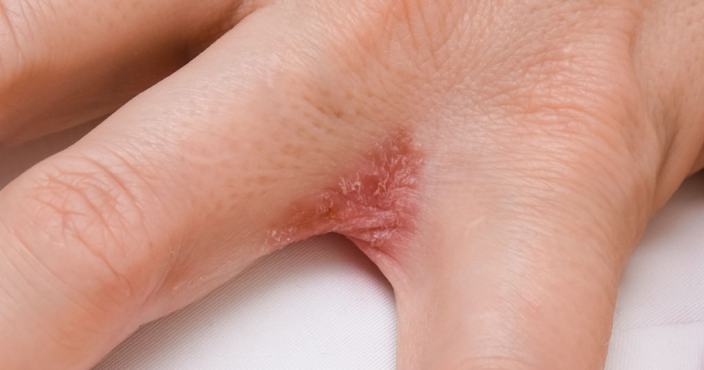 Hand with interdigital dermatitis, dyshidrotic eczema on hand close up.
