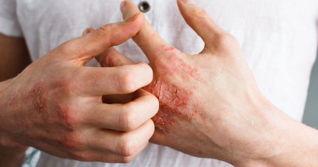 The problem with many people - eczema on hand. White background. Man itchind skin.
