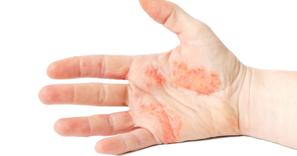 Close-up photo of a hand suffering of eczema
