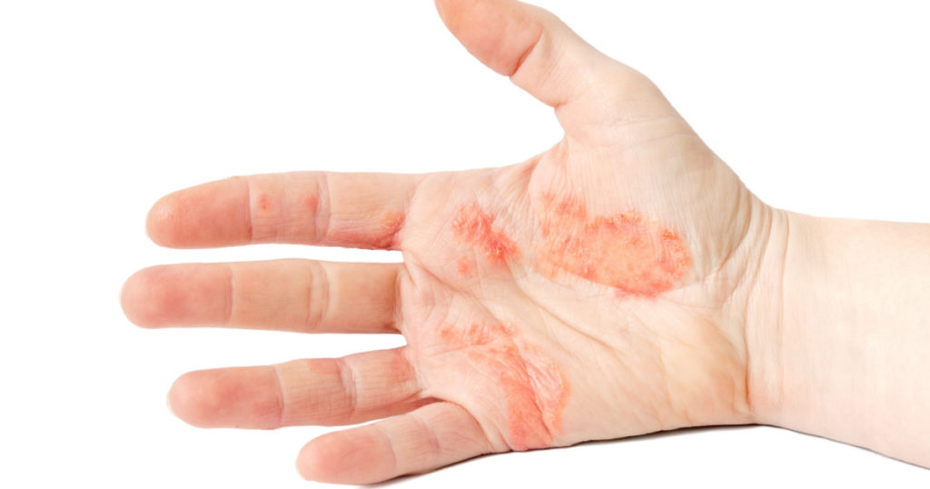 Close-up photo of a hand suffering of eczema 