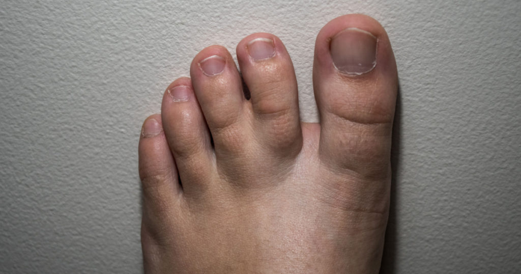 Webbed toes, syndactyly affecting the feet, fusion of two or more digits of the feet. Twin toes, mutation.