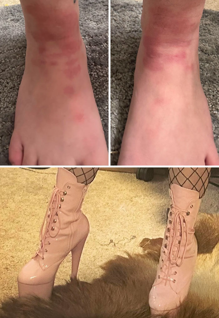 Ankles After 12 Hours in a Club in Heels