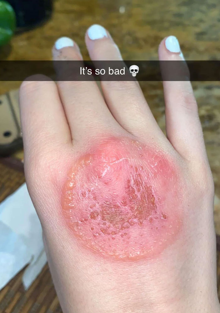 A Ringworm Infection Like No Other