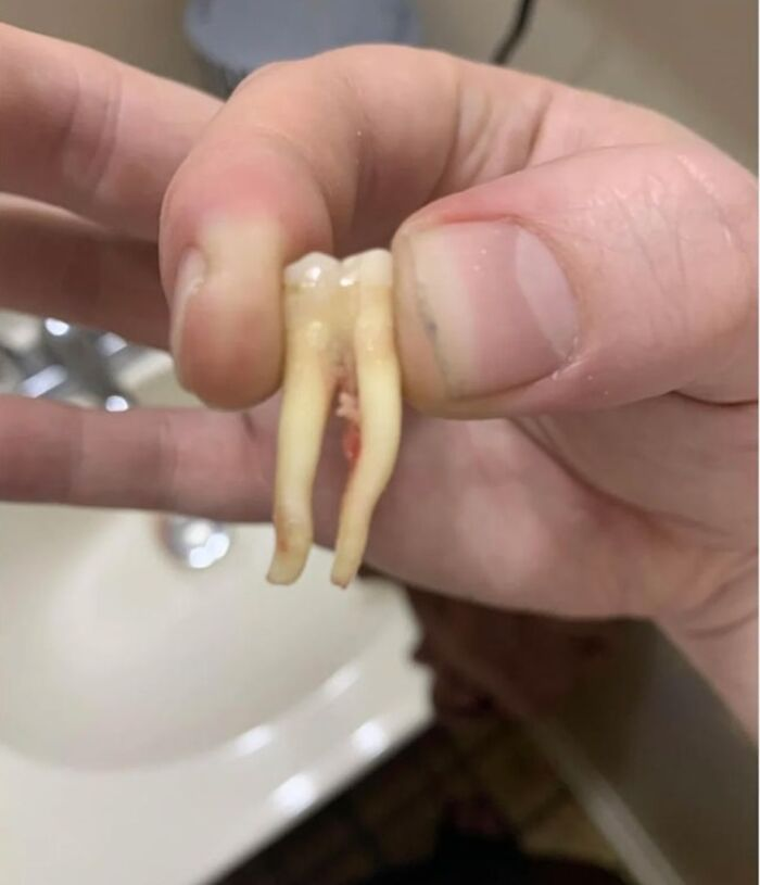 Extra Long Roots on a Molar