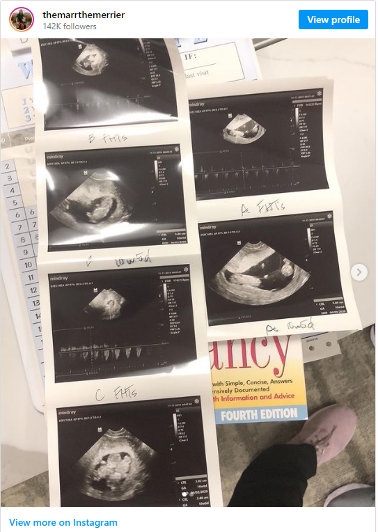 Instagram photo of babies in utero