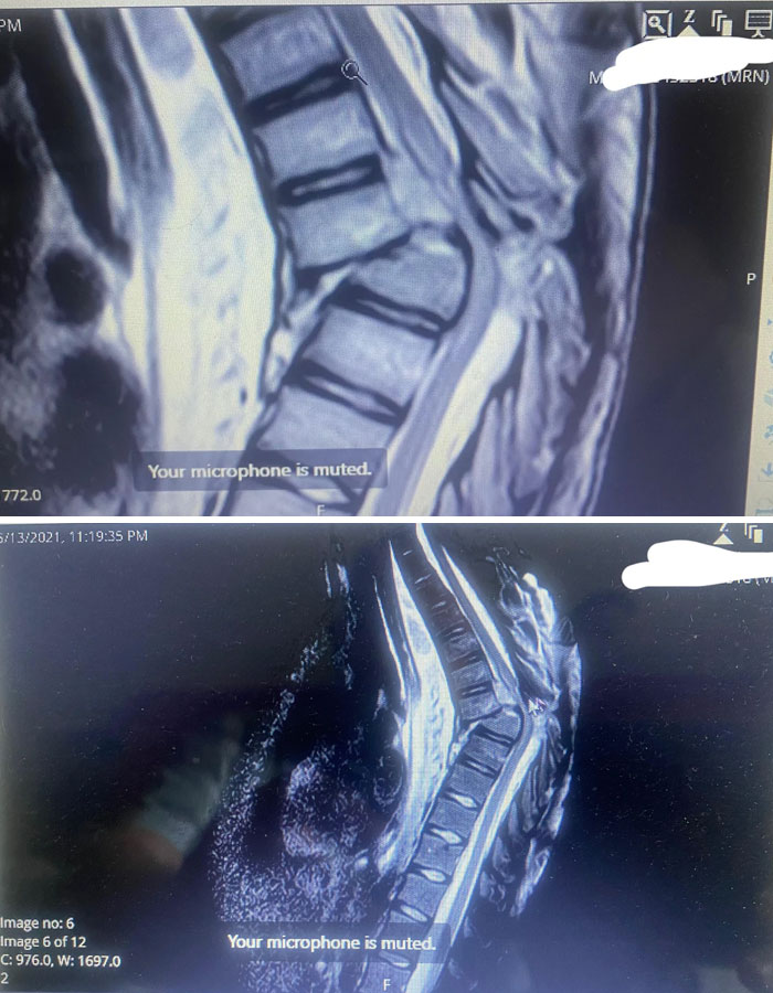 disturbing photos An X-ray of a Broken Back