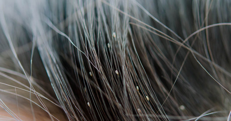 How to Prevent and Treat Head Lice in Children (and Adults) - Featured image